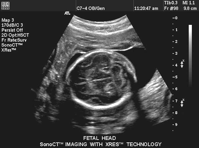 sonography test for pregnancy. Sonography During Pregnancy. during your pregnancy tool