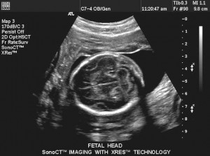Head of a Baby