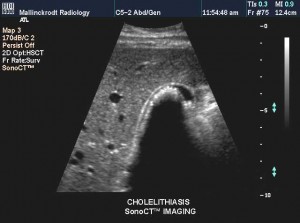 Gall Bladder Stones